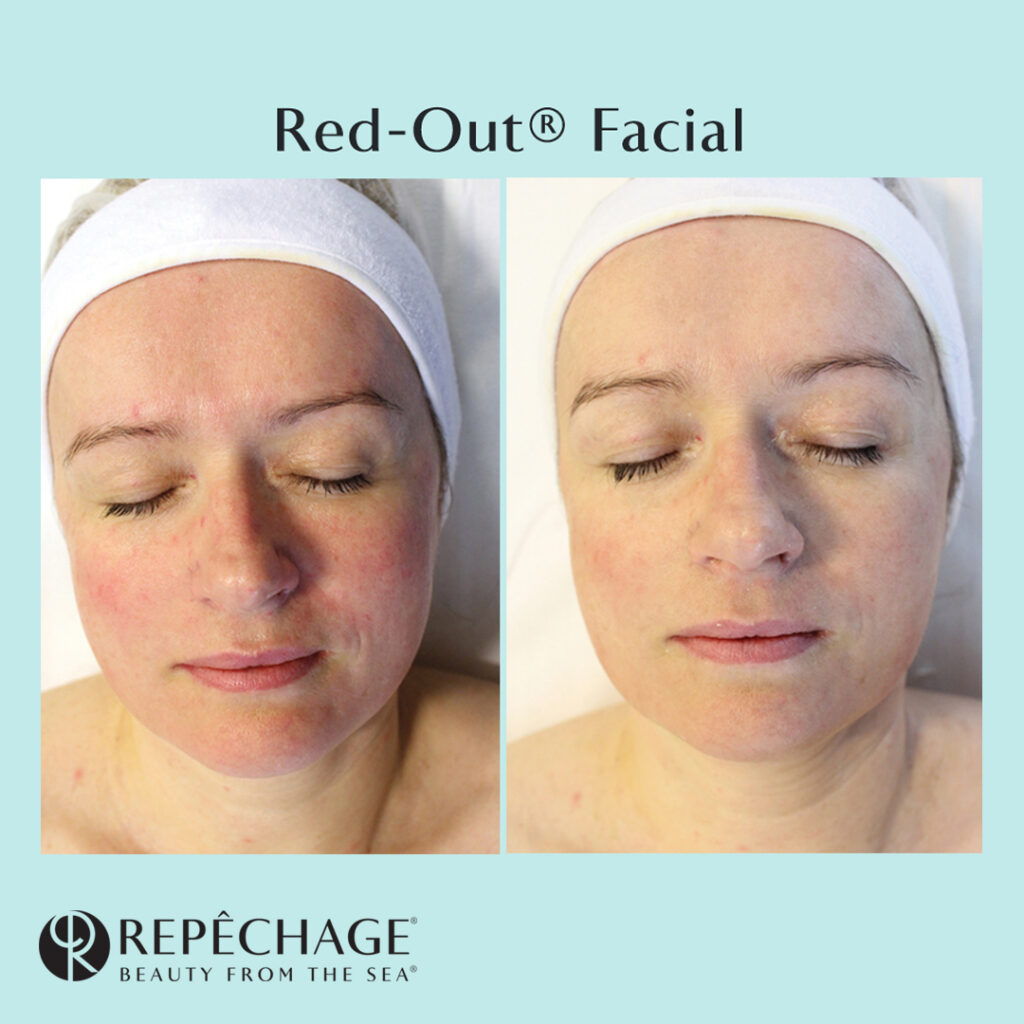 Rosaatsea: mis seda süvendab ja kuidas nahka rahustada